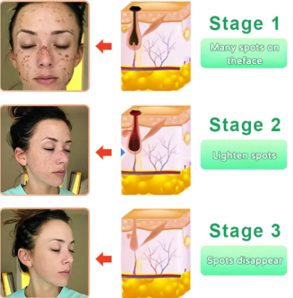 Gel Exfoliante Quarxery Original